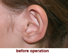 plastic-surgery-prominent-ear 